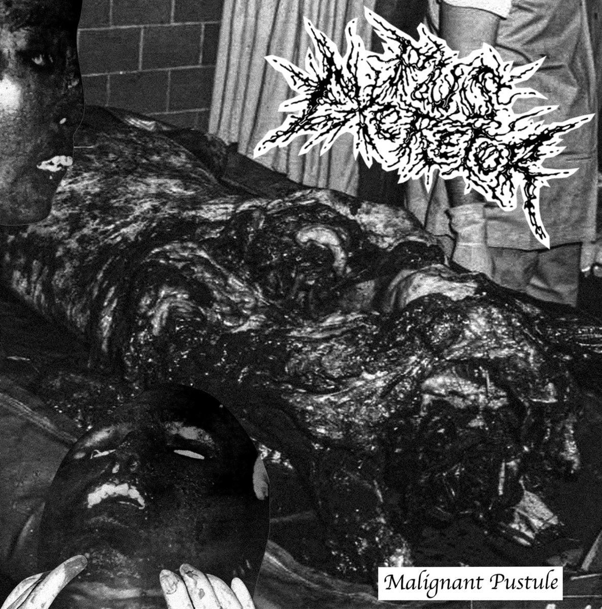 Pus Excretor - Malignant Pustule - Cassette